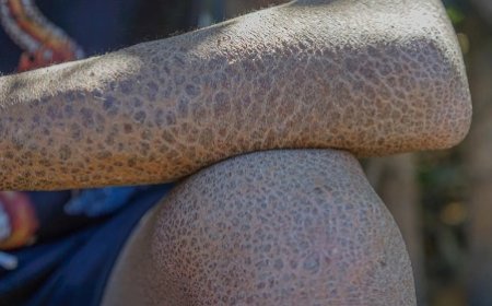 Peaux de serpents et regards qui tuent : la face cachée de l'ichtyose