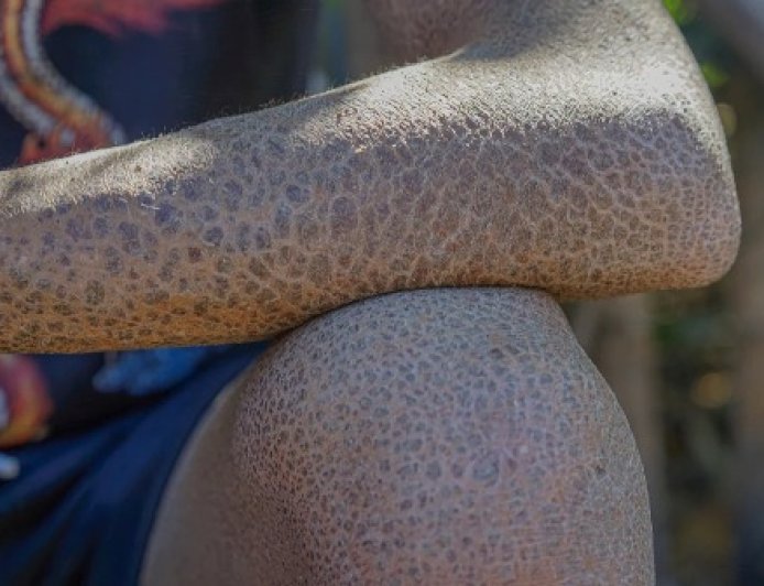 Peaux de serpents et regards qui tuent : la face cachée de l'ichtyose