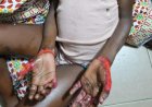 Yopougon : Une mère réclame justice pour sa fille de 6 ans après des faits présumés de brûlures à Abidjan